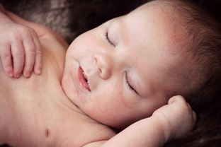 宝宝新生儿脐膨出怎么治